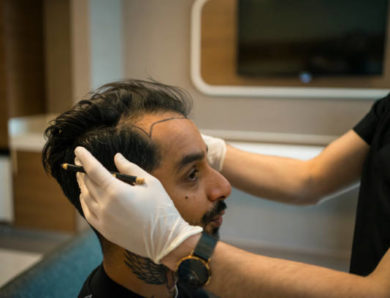 Peut-on faire une greffe de cheveux à Paris sur les tempes uniquement ?