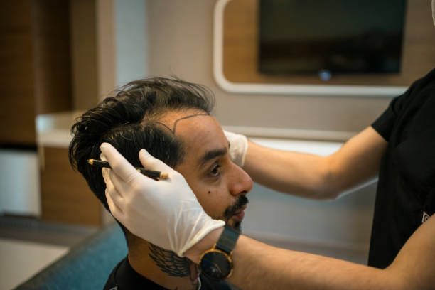 Peut-on faire une greffe de cheveux à Paris sur les tempes uniquement ?
